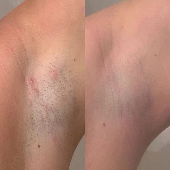 Depilação a laser (corpo inteiro ou áreas)